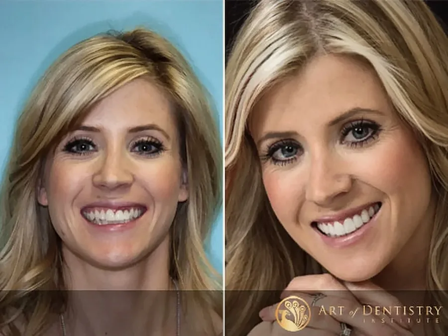 A patient before and after treatment at the Art of Dentistry Institute