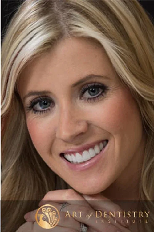 The same patient's smile after porcelain veneers